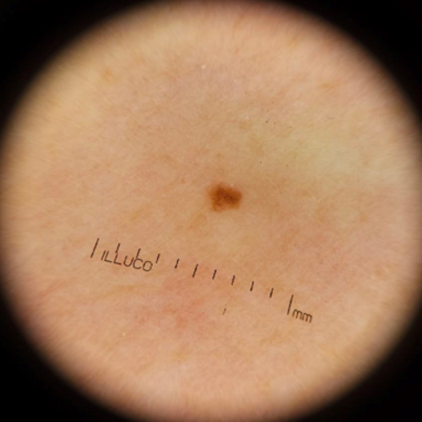 Bőr fotó - dermatoszkóppal IDS 9100 KERESZTPOLARIZÁLT