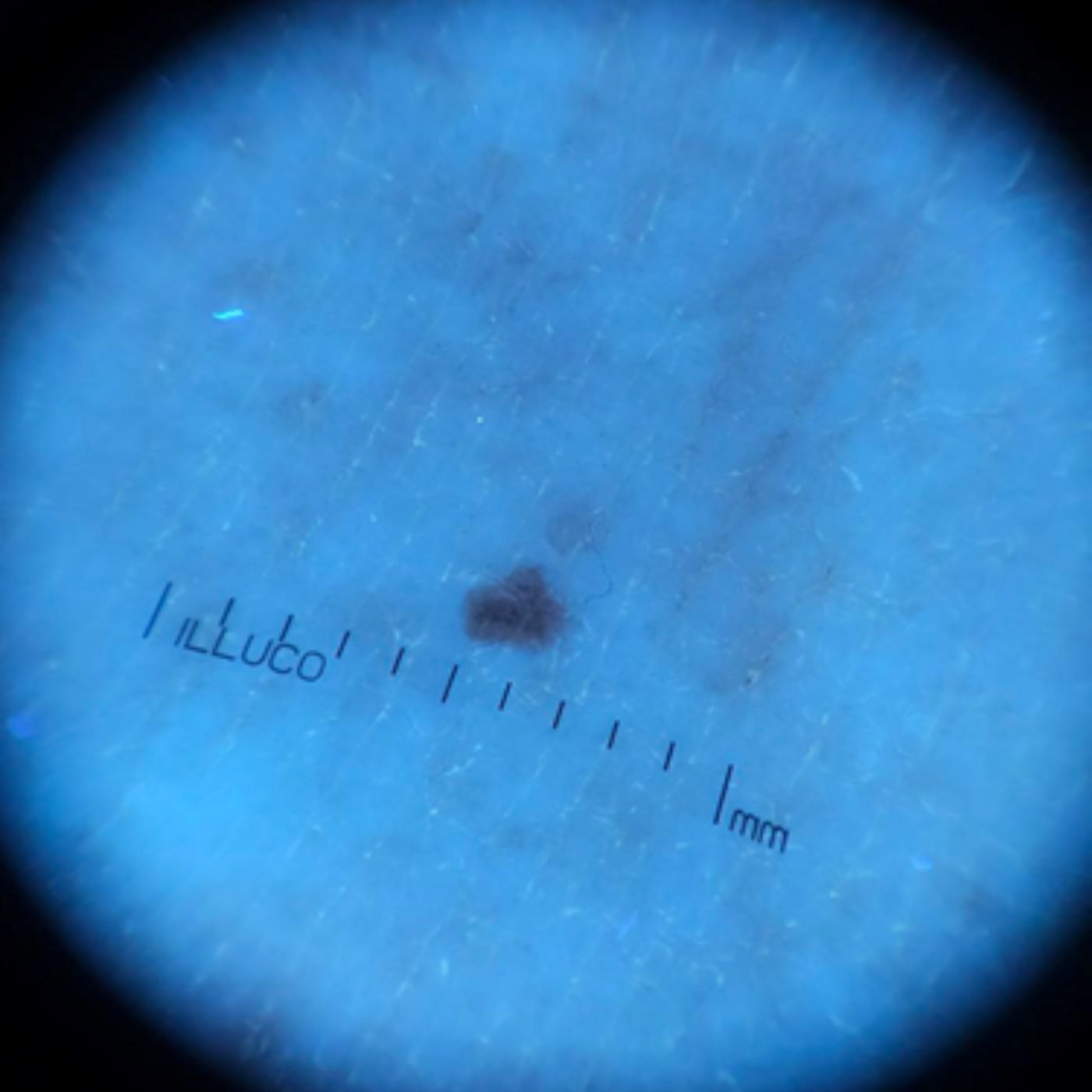 Bőr fotó - dermatoszkóppal IDS 9100 UV FÉNNYEL