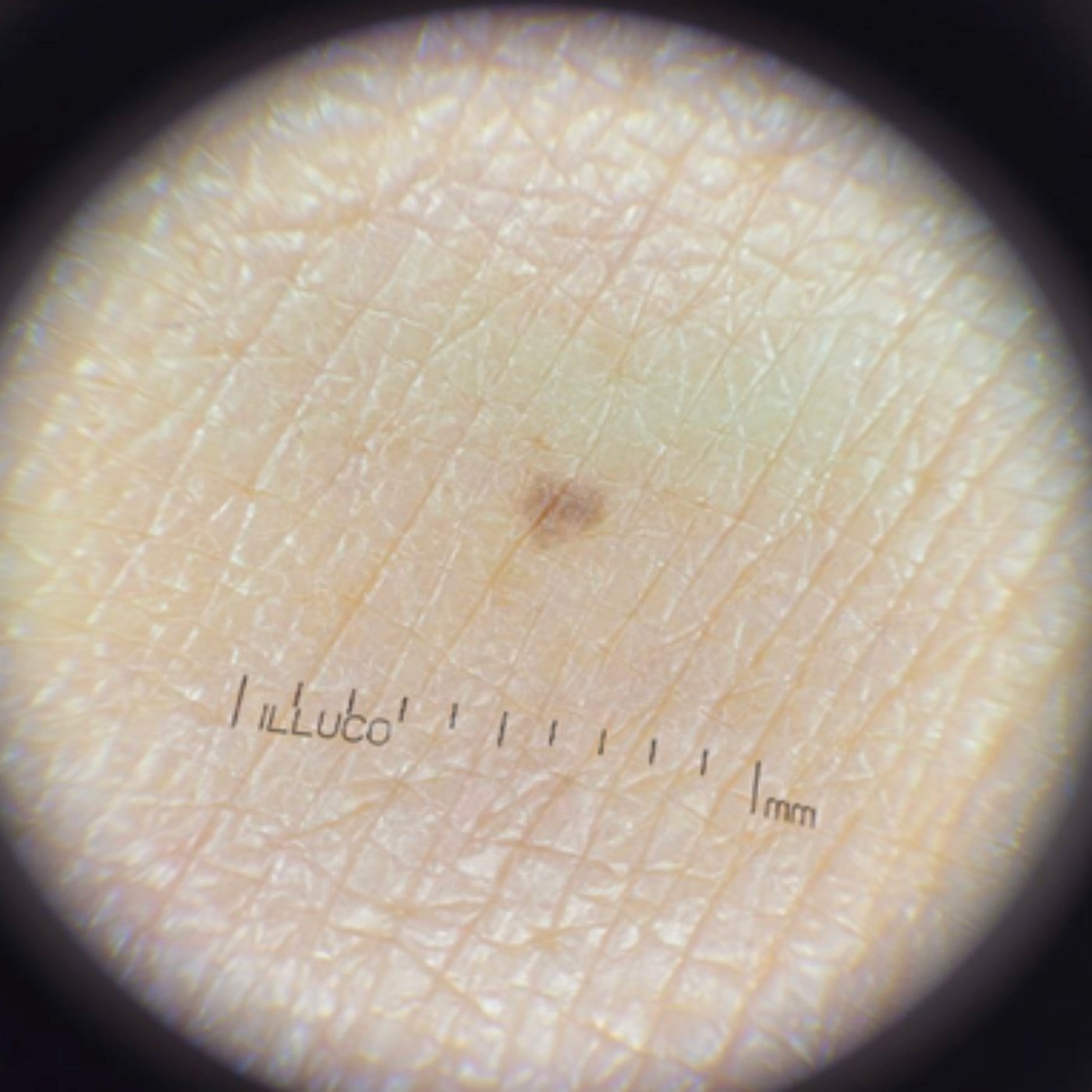 Bőr fotó - dermatoszkóppal IDS 9100